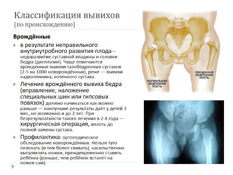Классификация вывихов (по происхождению) Врождённые в результате неправильного внутриутробного развития плода— недоразвитие суставной впадины